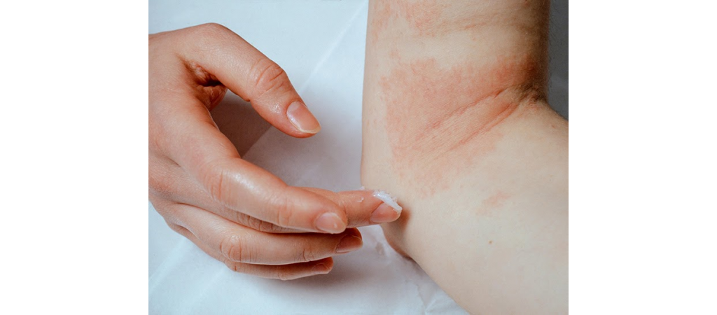 How To Choose The Right Eczema Cream?