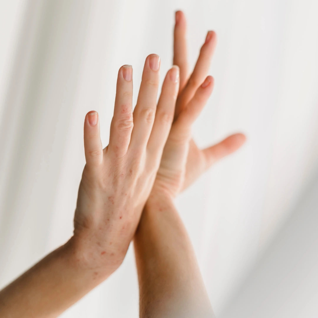 Understanding Contact Dermatitis: Causes, Prevention, and Care in the Post-COVID Era feature image