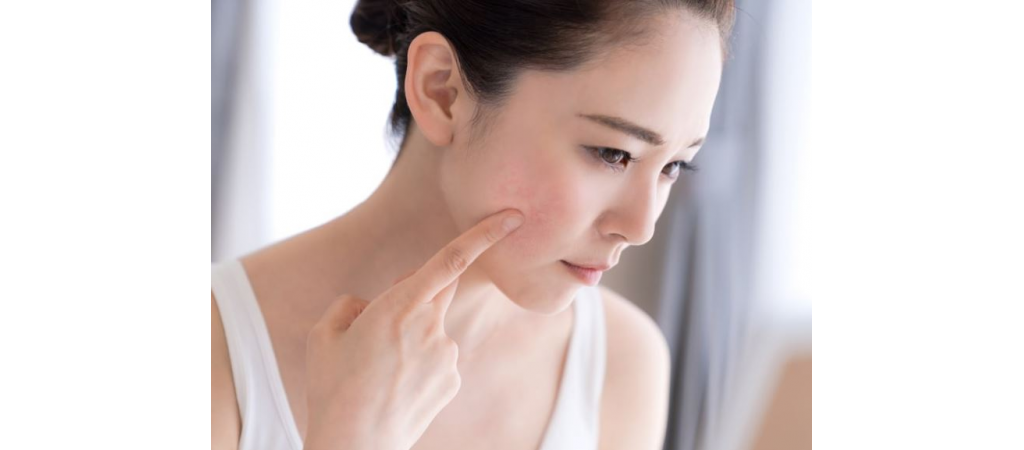 All You Need To Know About Eczema feature image