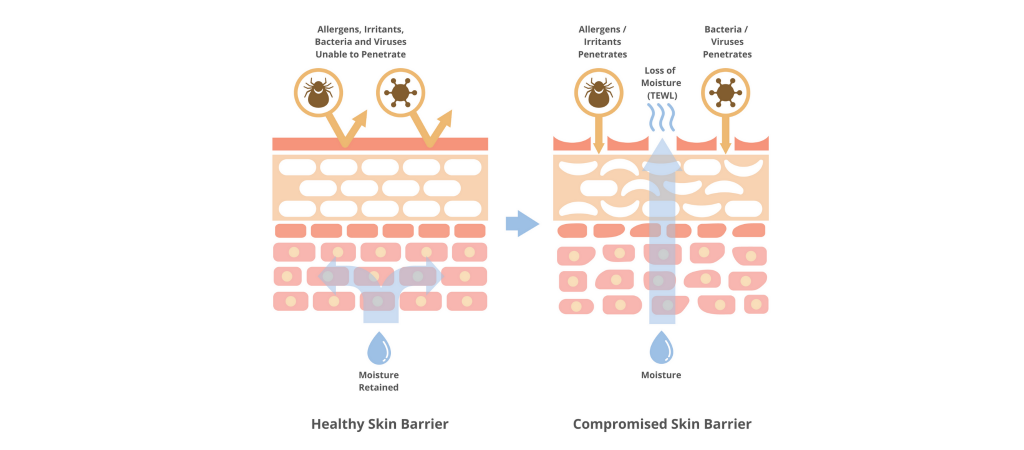Compromised Skin Barrier – What Is It? Find Out If You Have It. feature image