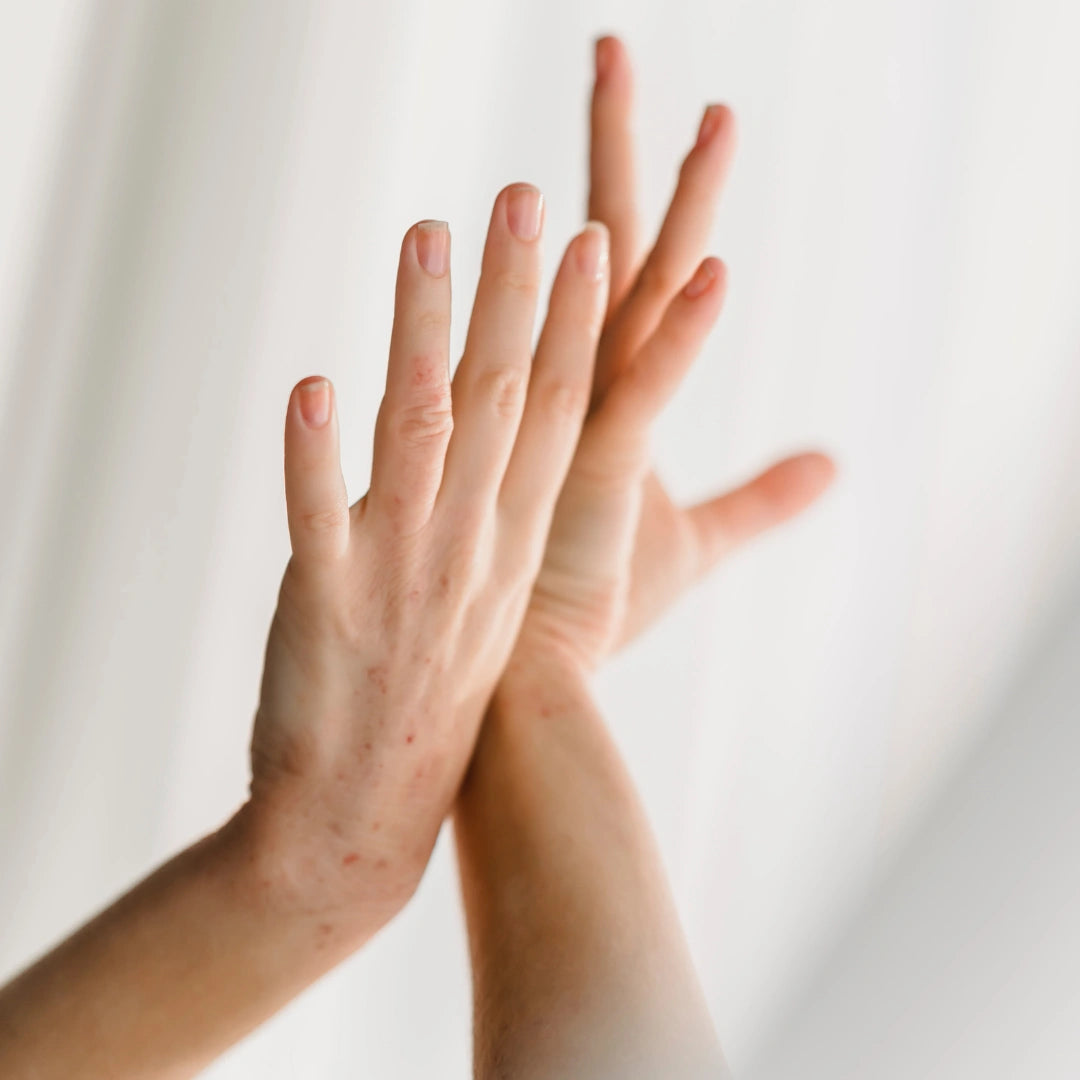 Hands Contact Dermatitis 