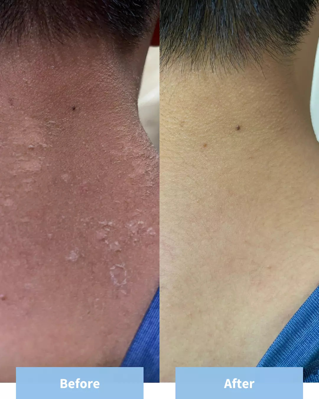 Child Back Before and After Simply Better Barrier Moisturiser